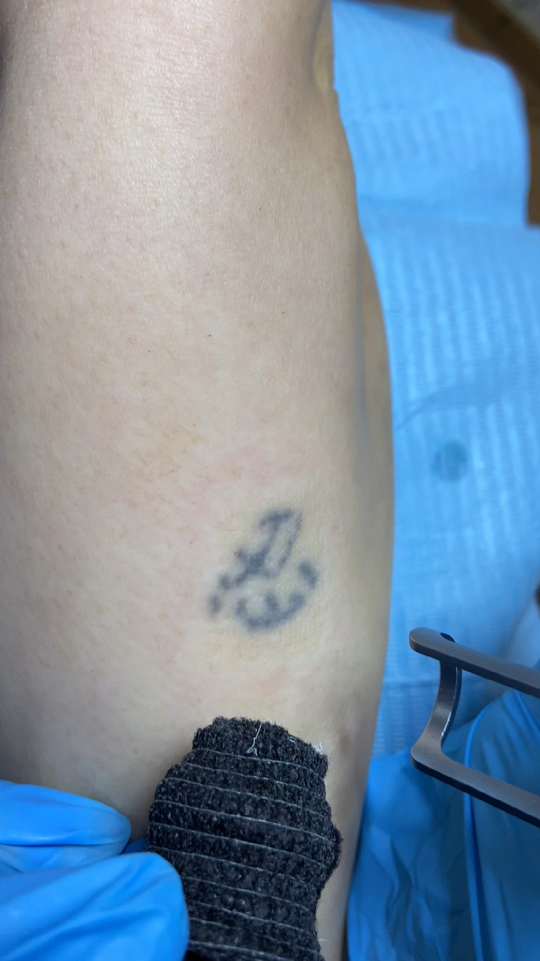 洗纹身#无痛皮秒洗纹身,清洗第一次.