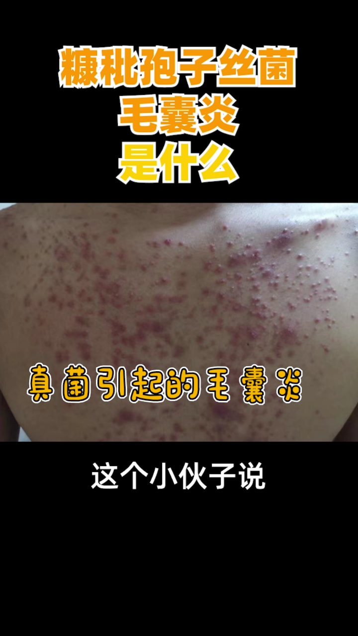 糠秕孢子丝菌毛囊炎,是什么?