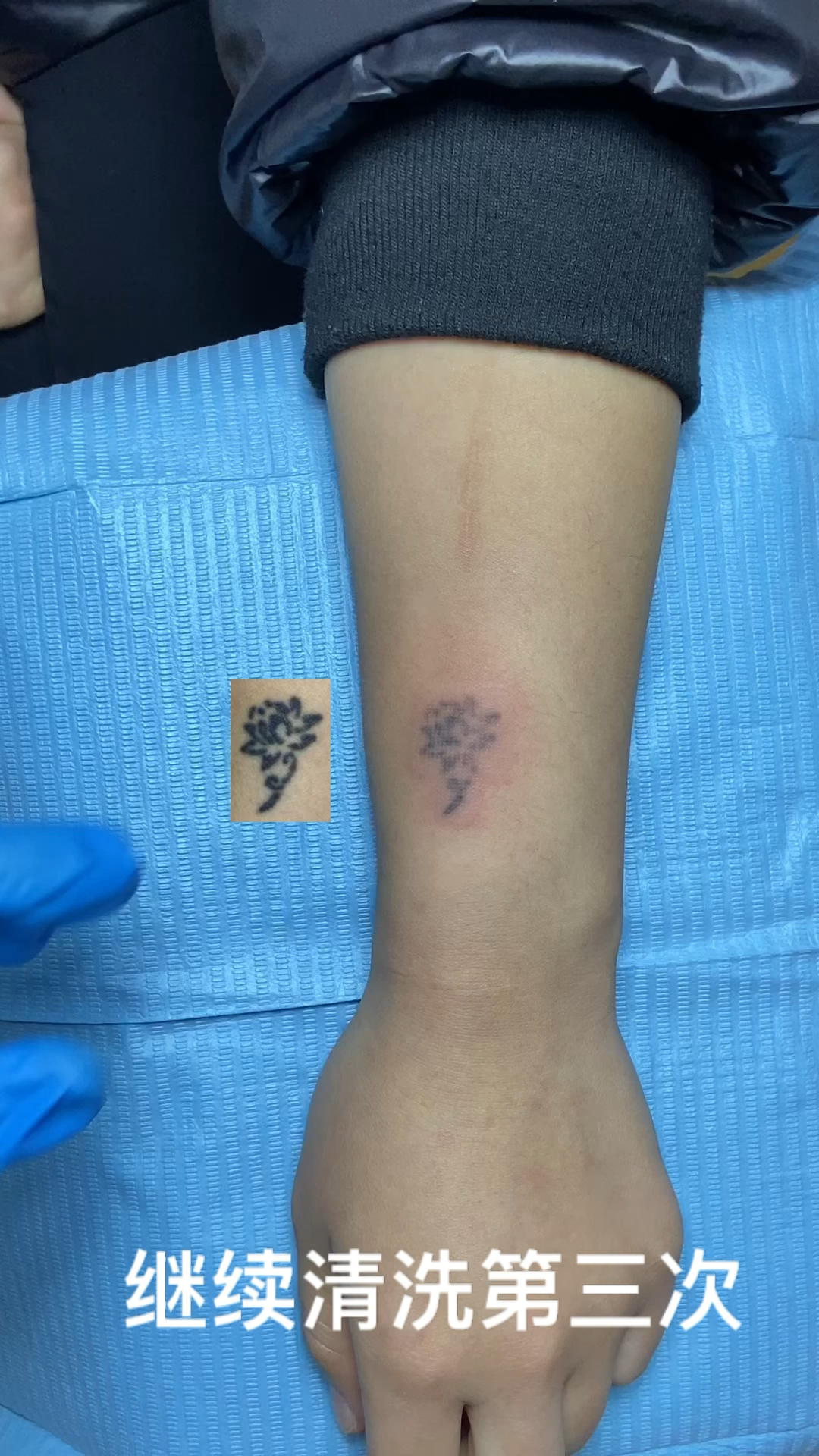 廊坊洗纹身第一视角洗纹身无痛皮秒洗纹身清洗两次效果60洗之前纹身