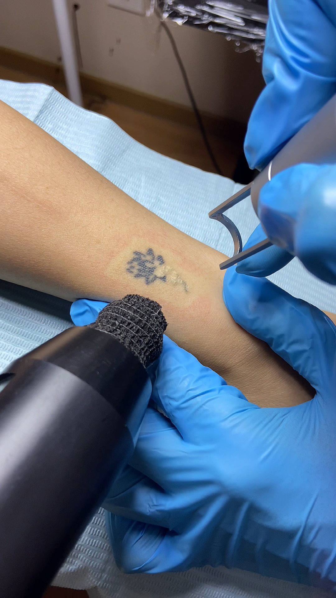 洗纹身#无痛皮秒洗纹身,清洗第一次.