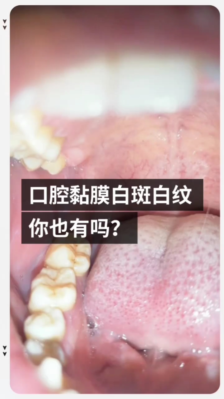 口腔扁平苔藓白斑白纹你有吗?