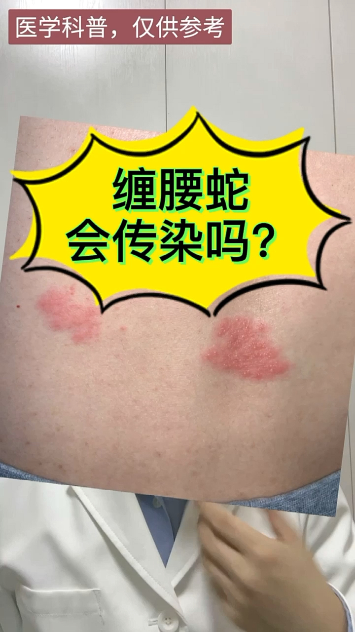 全民医生说#缠腰蛇会传染吗?-度小视