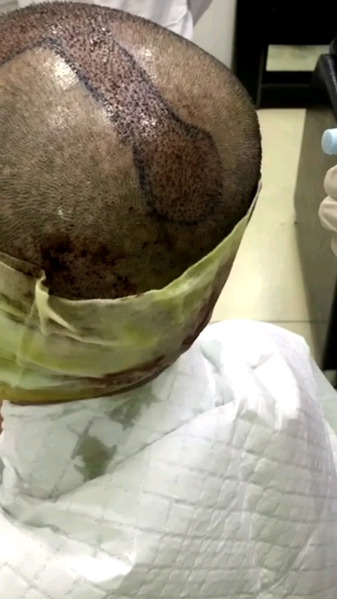 种发第二天,看着害怕,其实一点都不疼的.从此告别单身和自卑!