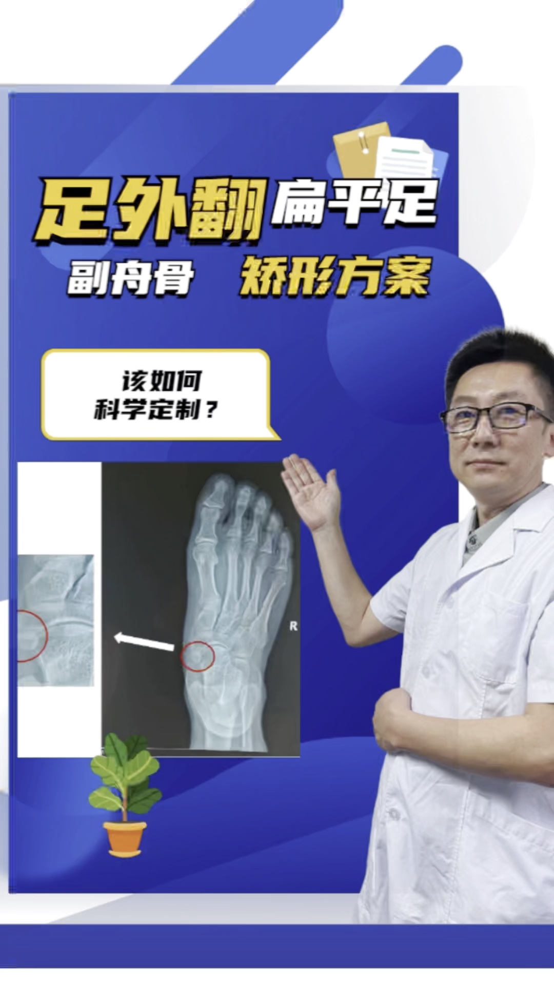 育儿副舟骨足外翻扁平足怎样选择矫形方案最合理