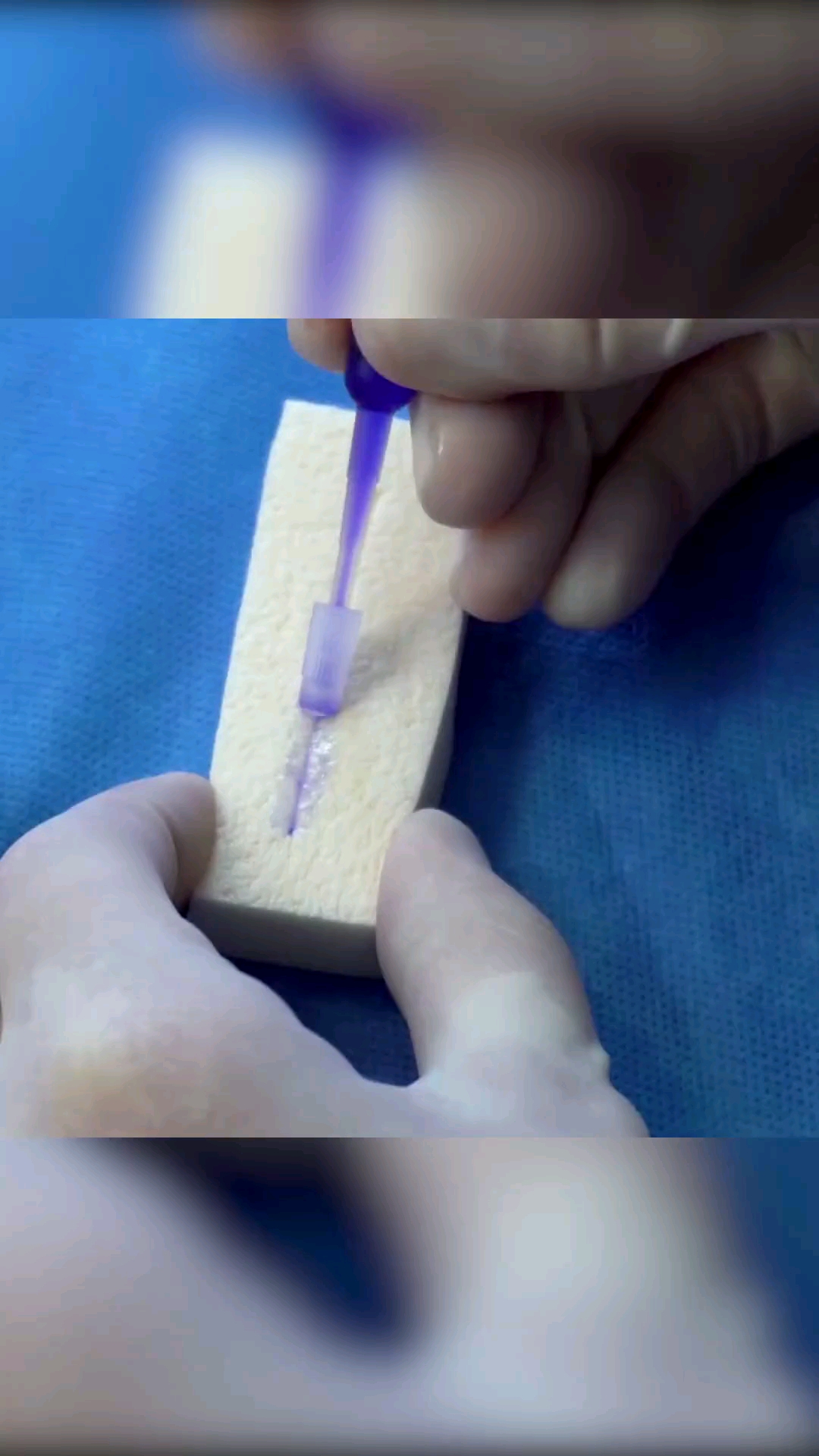 医用胶水被发明60秒闭合伤口