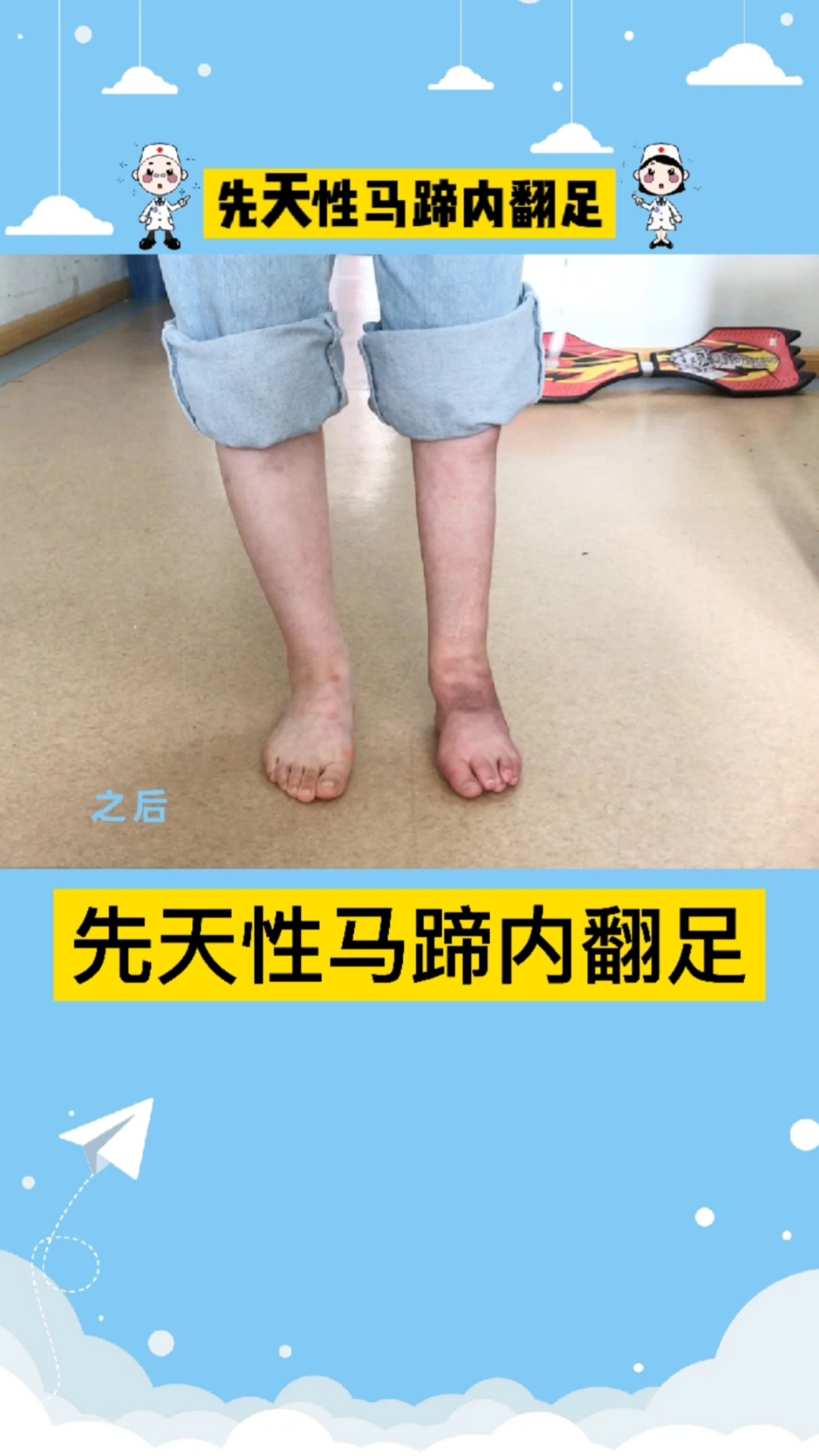 马蹄内翻足你一定想象不到重新体会双脚正常行走的感觉马蹄内翻足治疗