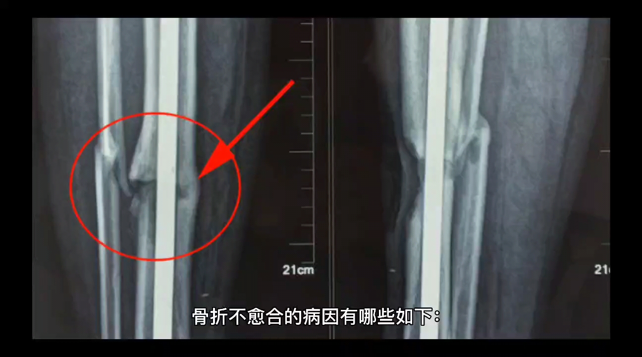 重度贫血,肌肉萎缩#肌肉萎缩骨折不愈合怎么办?