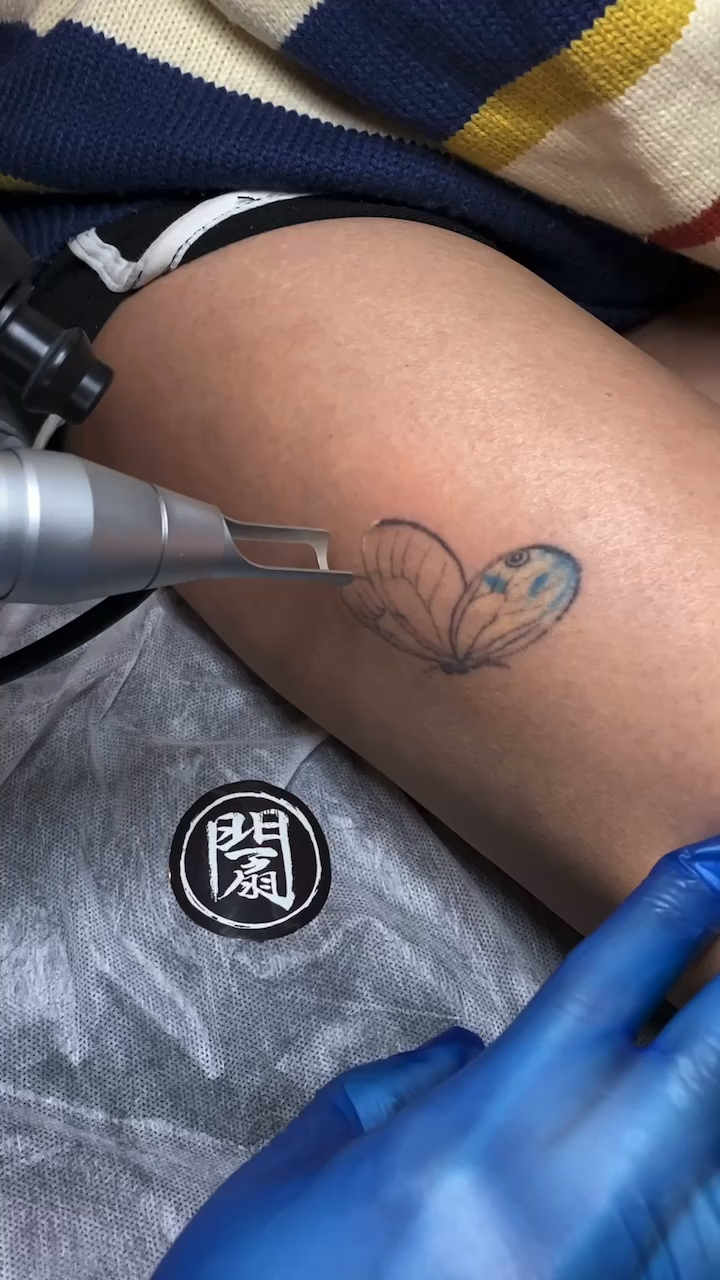 洗纹身#超皮秒洗大腿纹身