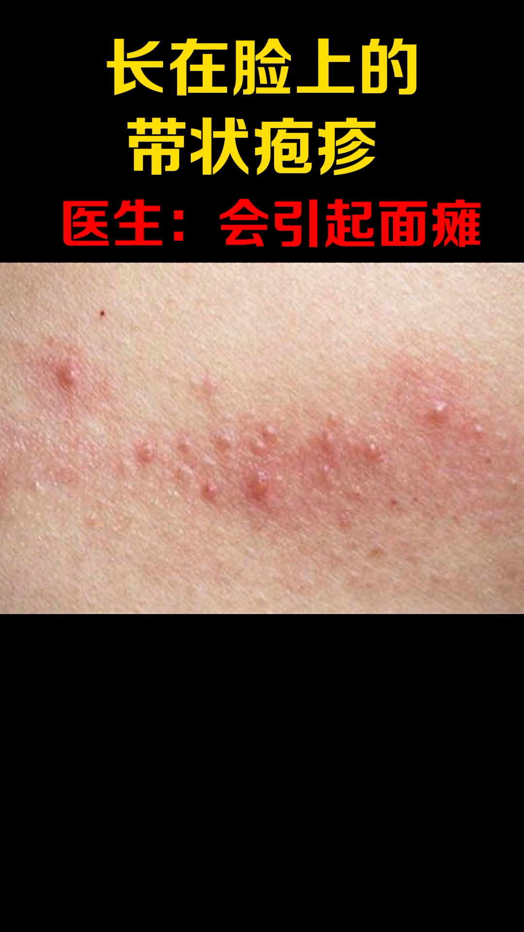 健康养生长在脸上的带状疱疹医生直言会引起面瘫视力听力下降