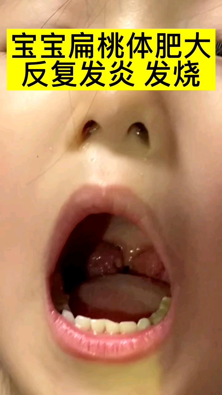 儿童扁桃体肥大发炎引发家长朋友重视