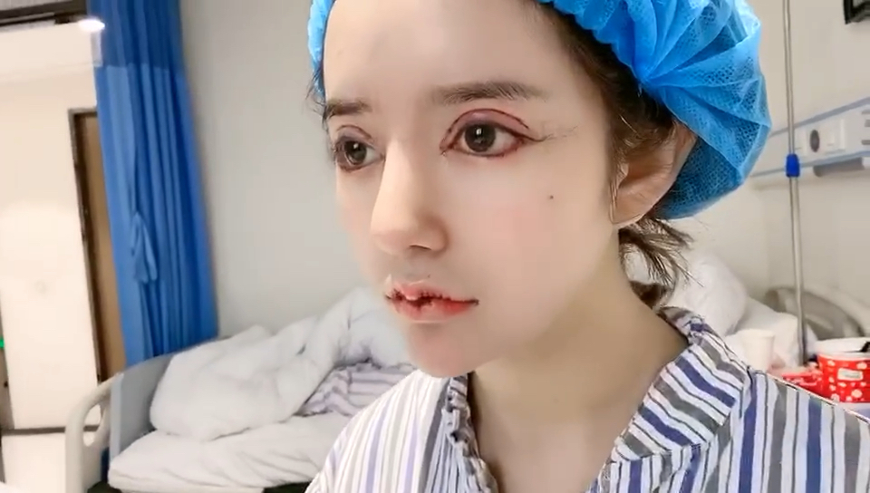 迷惑行为大赏#芭比眼综合m唇术后第二天