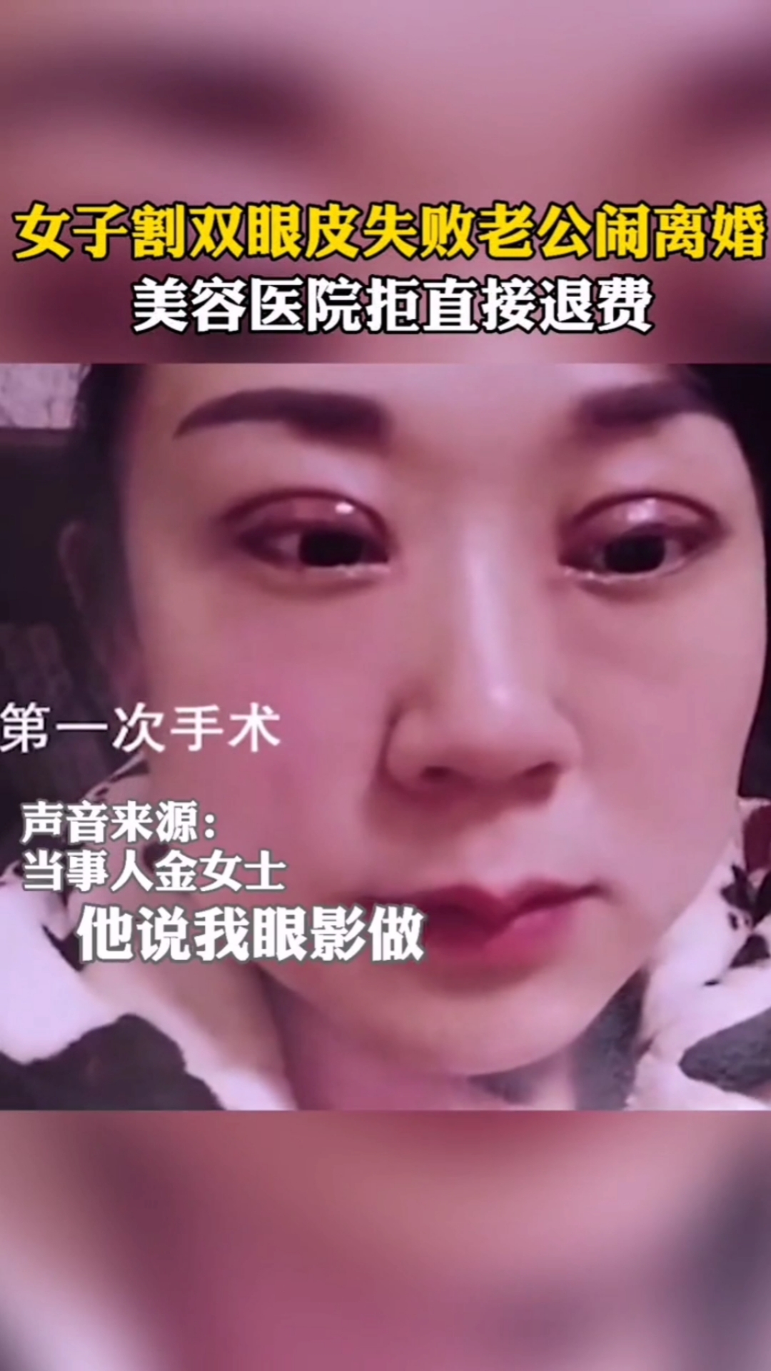 婚姻家庭#女子割双眼皮失败老公闹离婚!美容医院拒绝