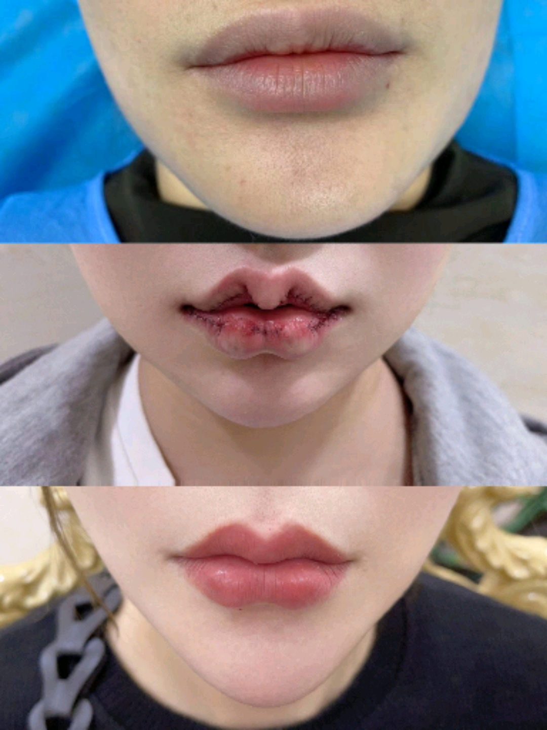 m唇手术对比照切口图片