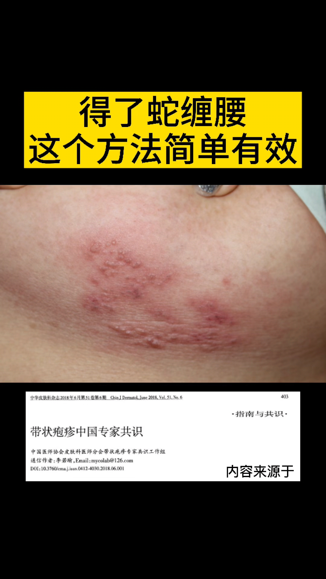 全民正能量得了蛇缠腰很痛苦不用怕用这四条帮到你