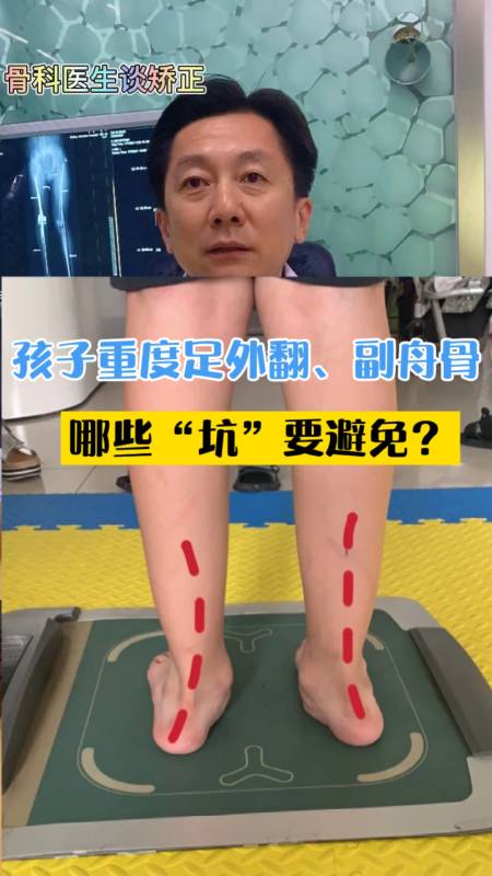 健康科普#孩子重度扁平足外翻,伴随有副舟骨疼痛,哪些"坑"要警惕?