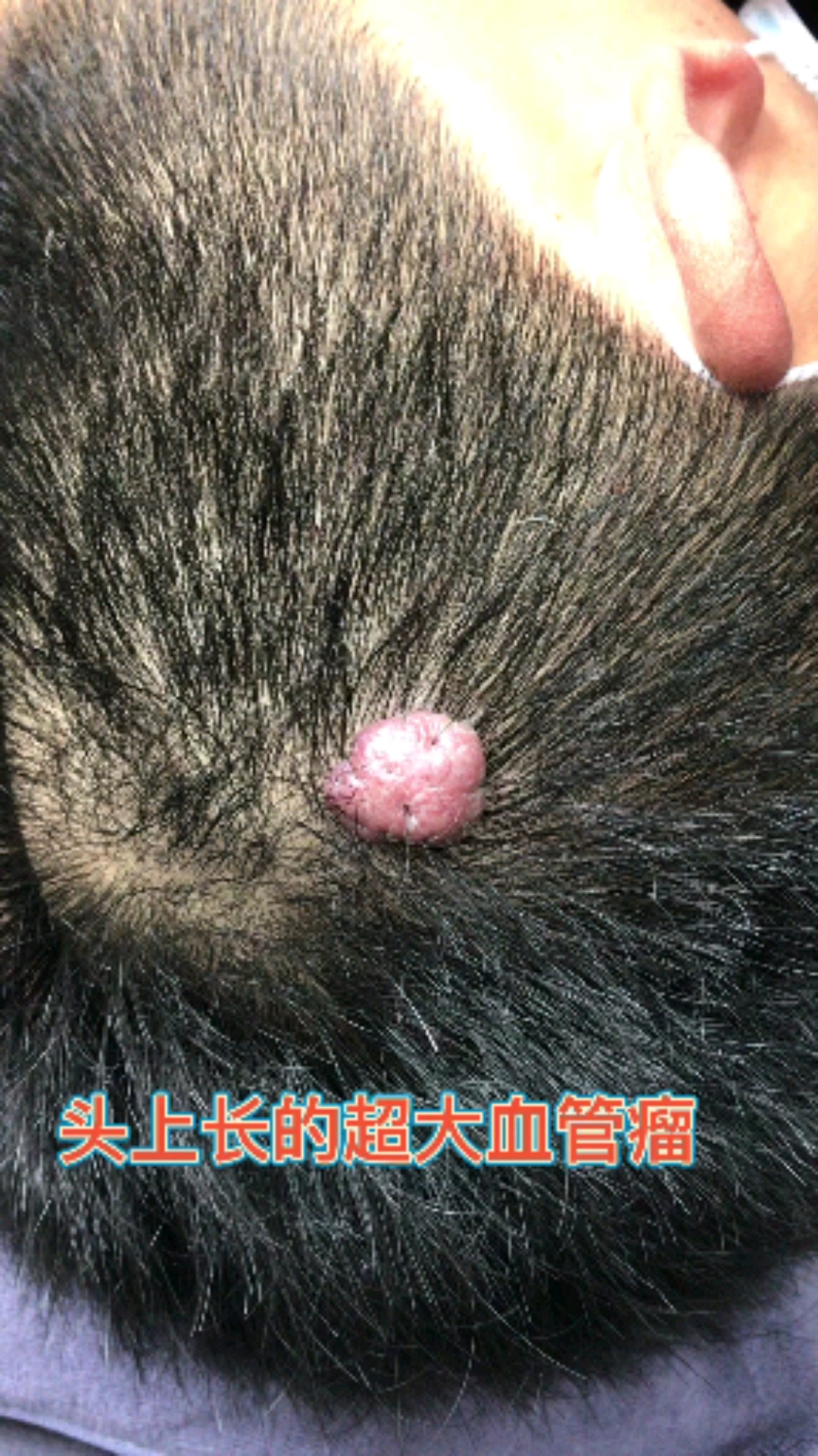 头上的大肉瘤,看看恢复的咋样?