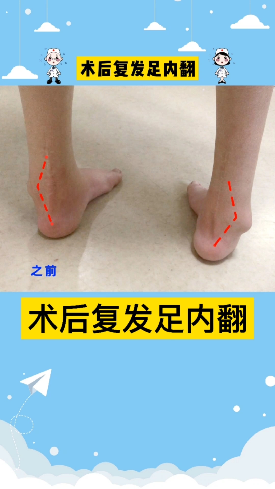 7岁小女孩开刀手术后还是复发了足内翻,这次选对了地方,可以无创治 