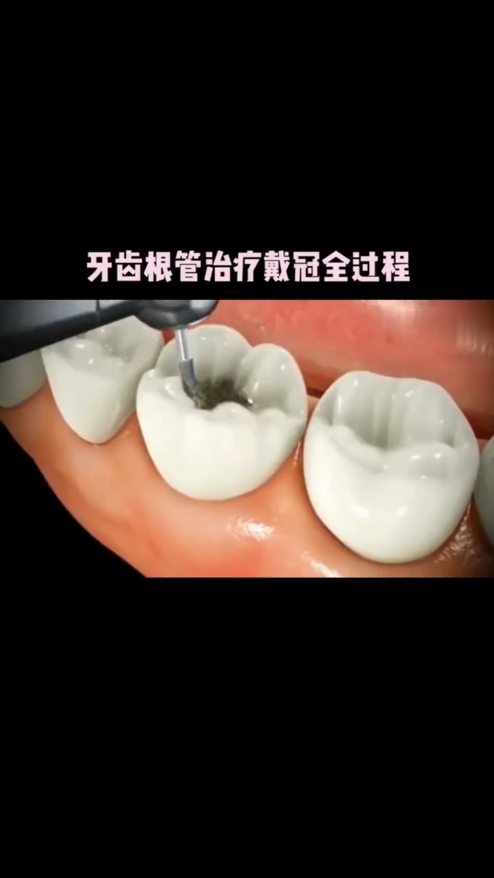 根管治疗照片图片