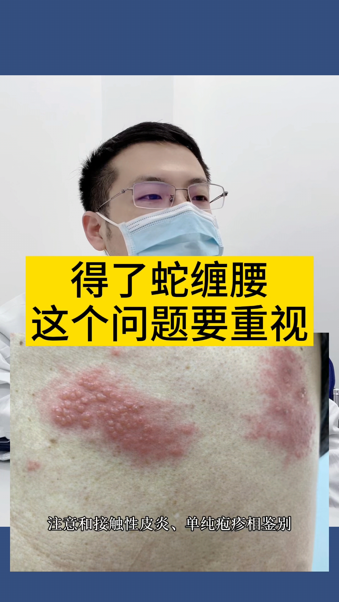#带状疱疹#得了蛇缠腰这个问题要重视!-度小视