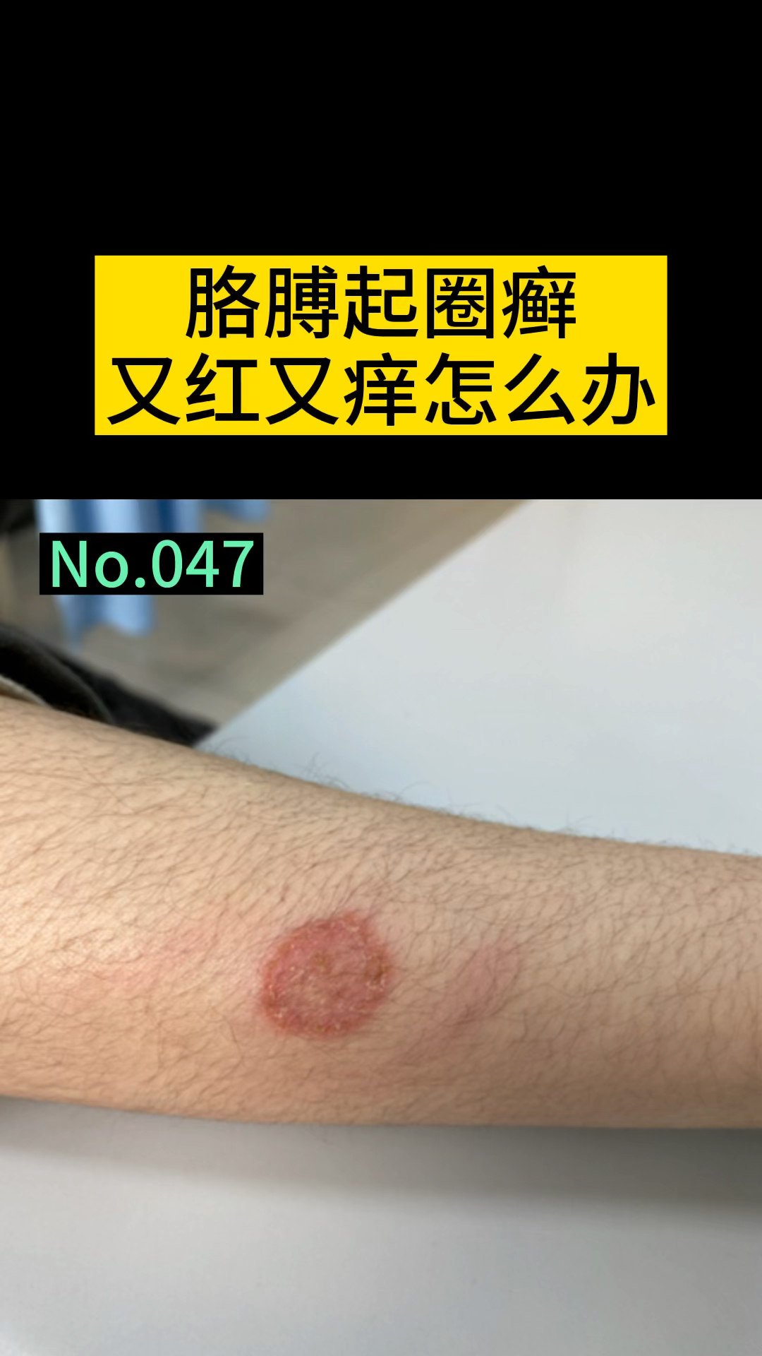 医学科普#胳膊上的癣,该怎么办呢-度小视