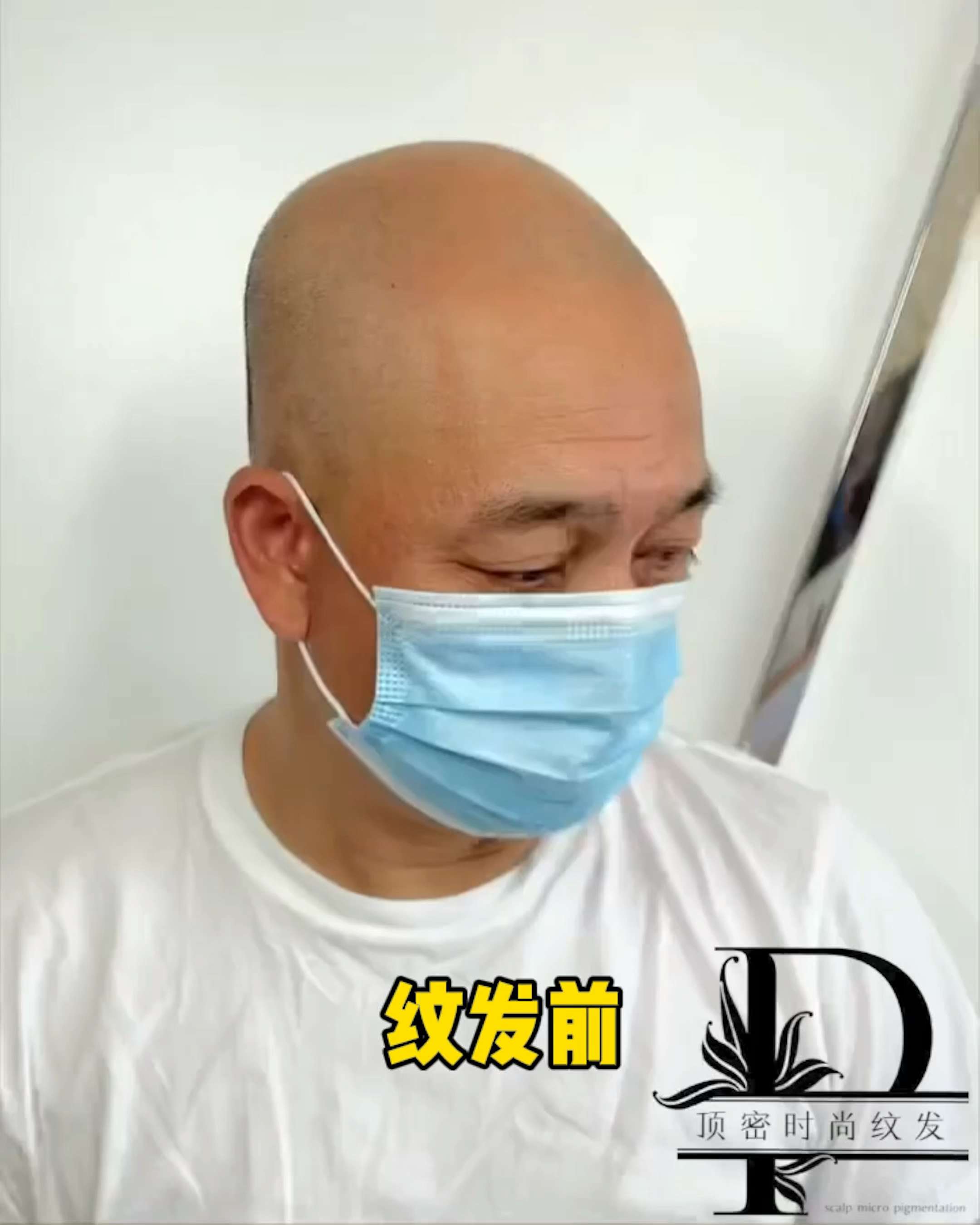 看来自南昌脱发客户纹发前后的完美蜕变,这就是脱发终结者!