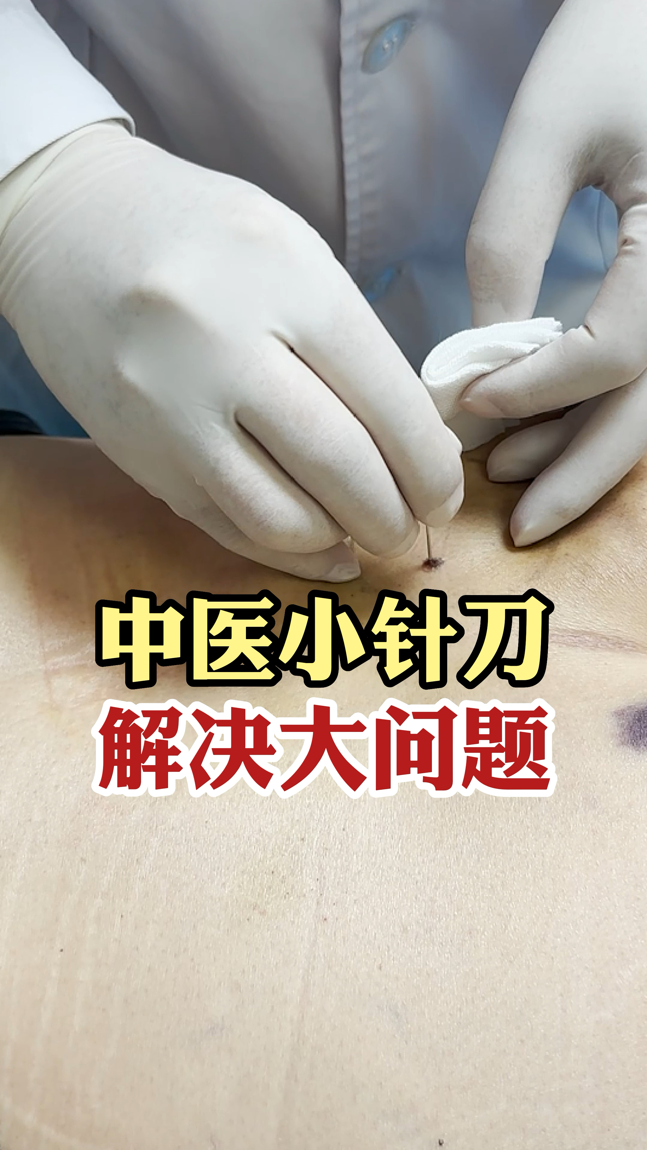 腰椎间盘突出#小针刀治疗腰椎间盘突出,缓解疼痛