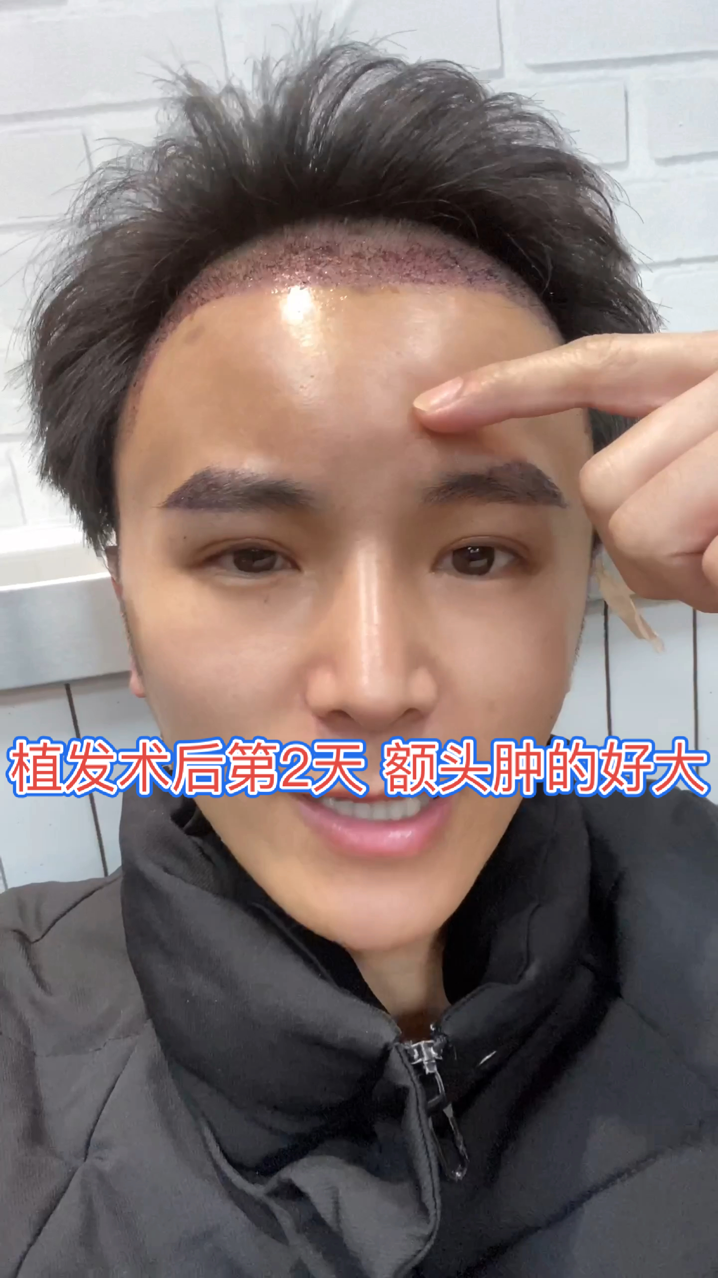 植发植发植眉术后第2天额头肿的好大植发发际线发际线种植