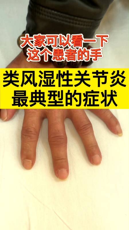 全民医生说这就是类风湿性关节炎最典型的症状
