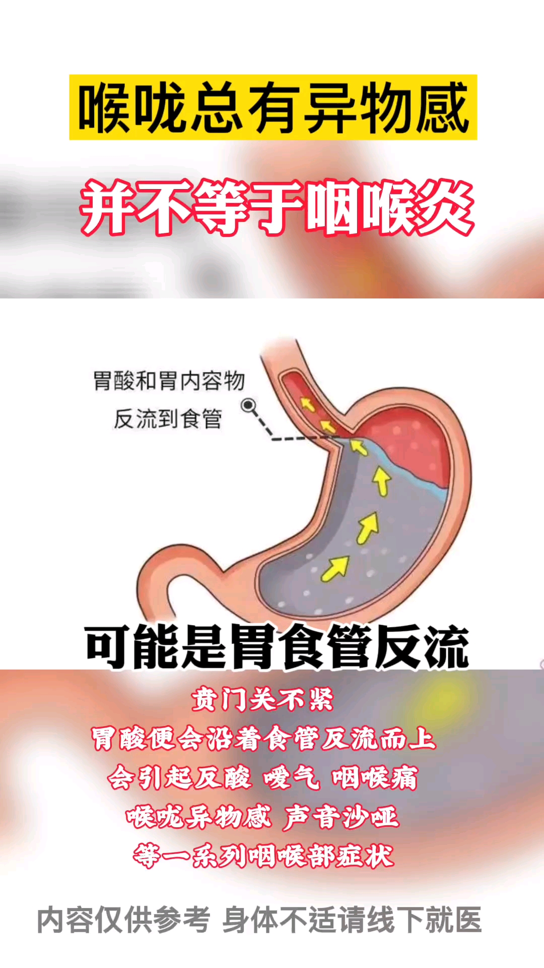 每日健康优选咽喉异物感有可能是胃食管反流