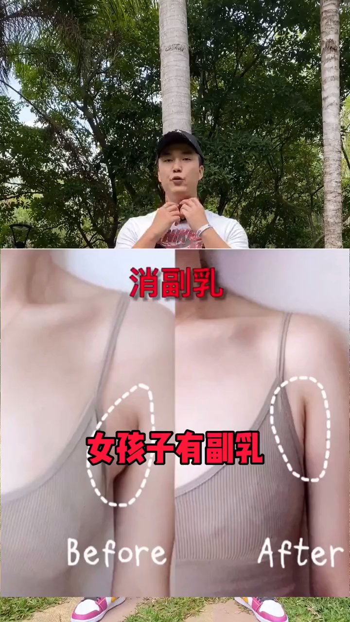 女性有副乳正常吗图片