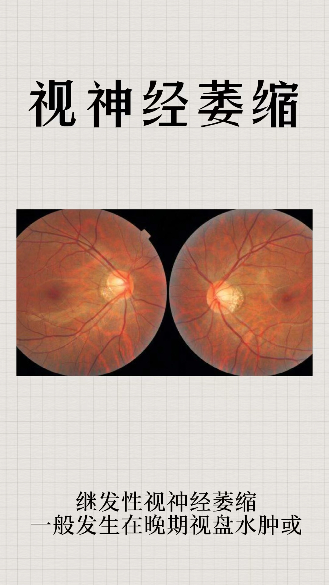 破壳计划继发性视神经萎缩