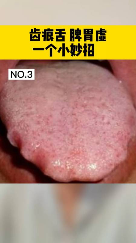 脾虚照照镜子看看你的舌头是这样的吗教你一个简单的小方法