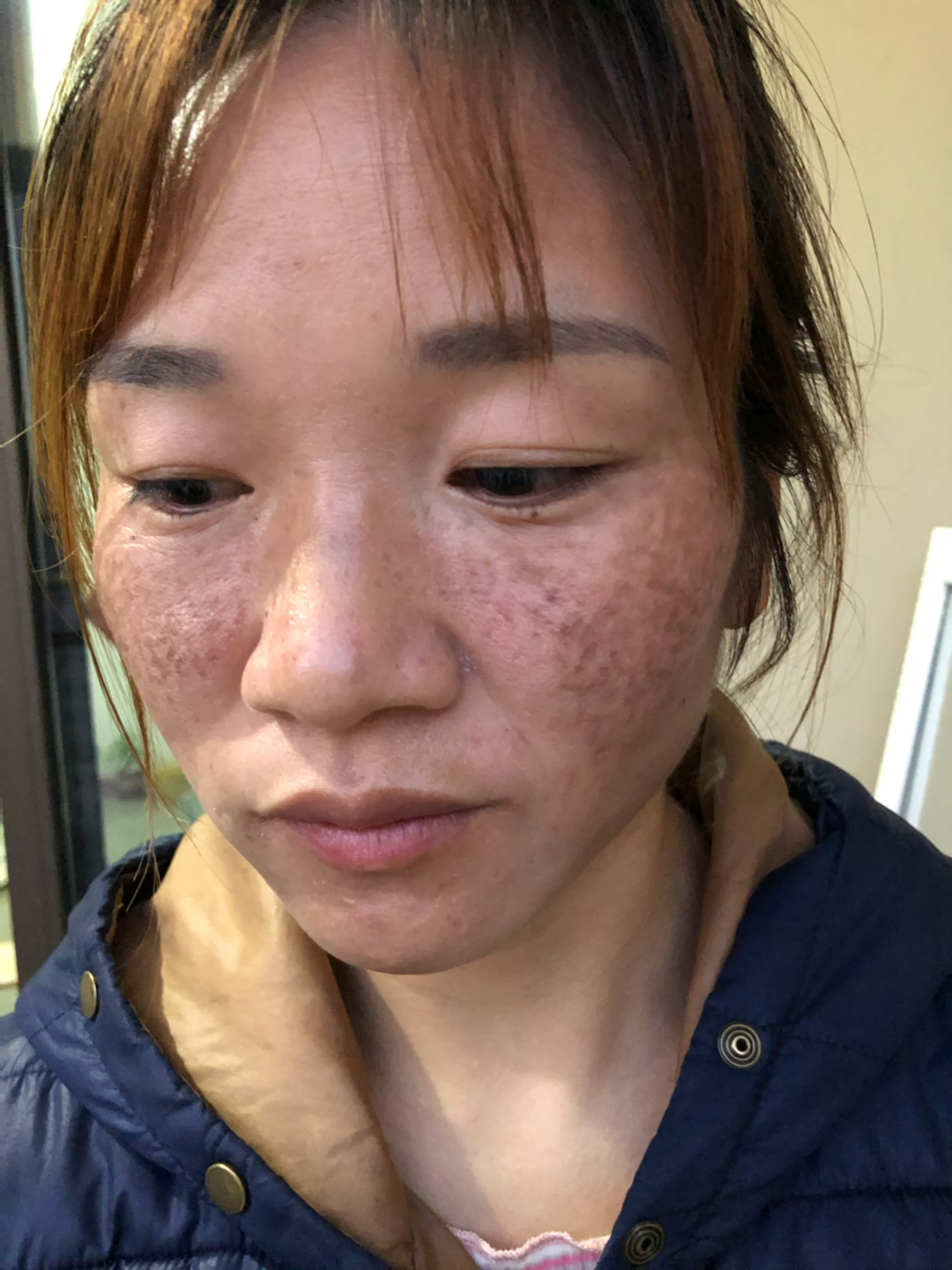 黑色素就这样消失了,脸上的斑点也是同样的,百分百祛除有效,一起变美