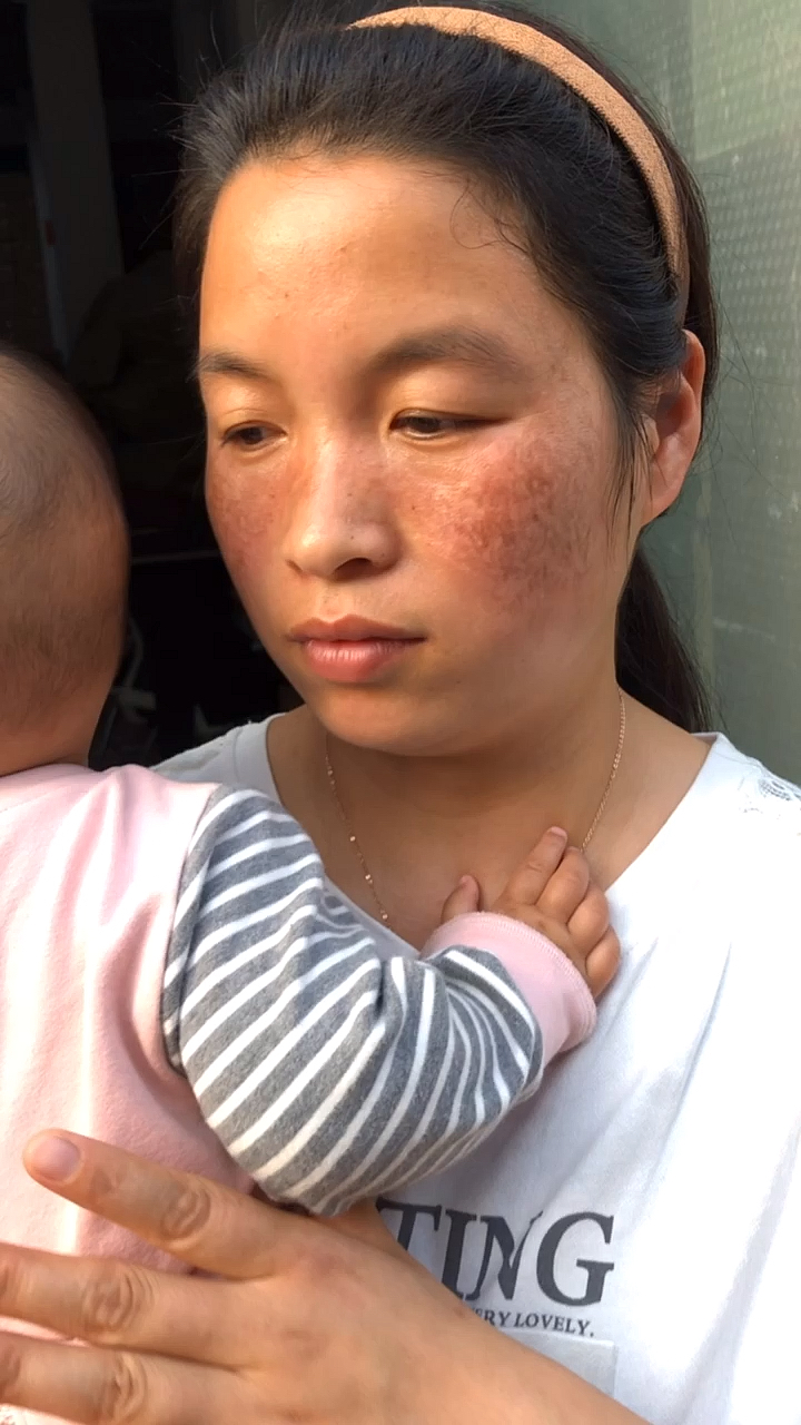 忘不掉那段满脸黑麻子的经历,希望抛弃我的那个你能够看到这个视频