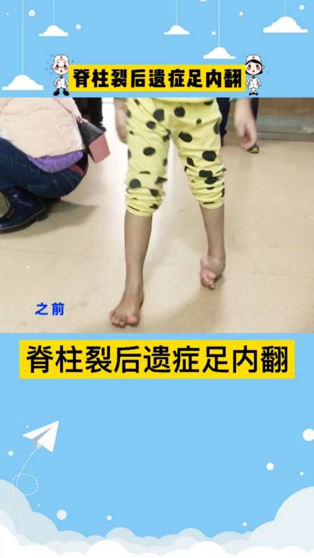 足内翻#脊柱裂也会引起足内翻.