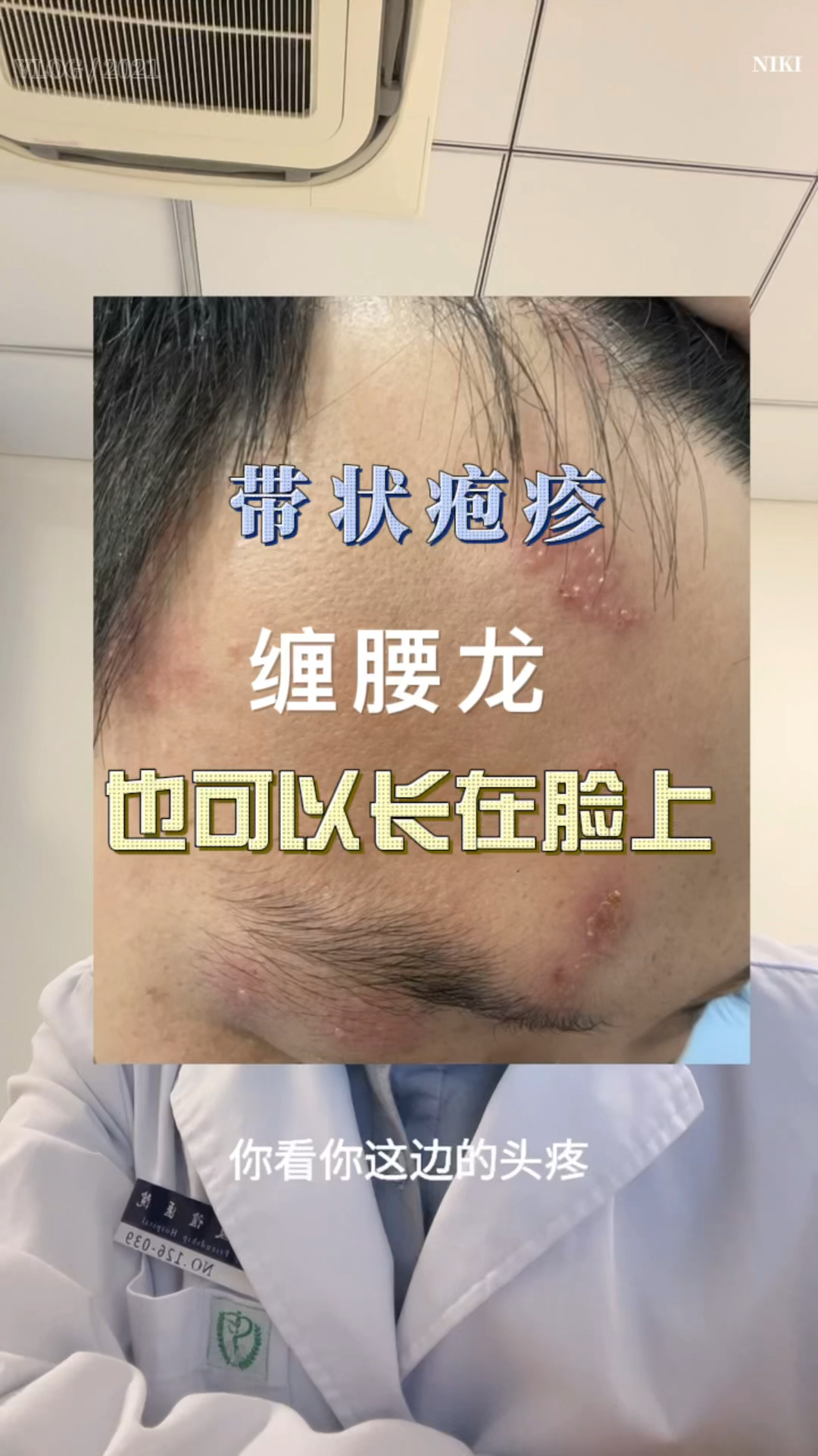 全民医生说缠腰龙也是可以长在脸上的有的人还挺疼需要积极治疗