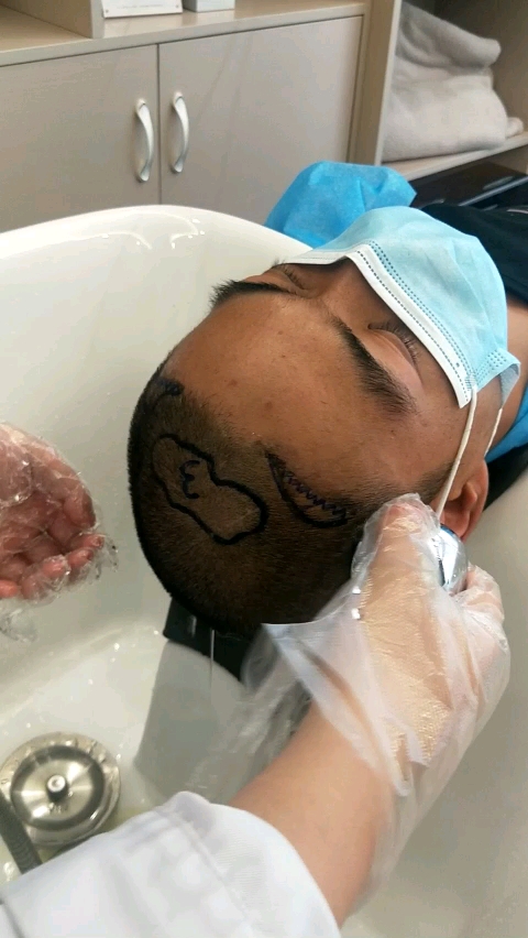 种发第二天,看着害怕,其实一点都不疼的.从此告别单身和自卑!