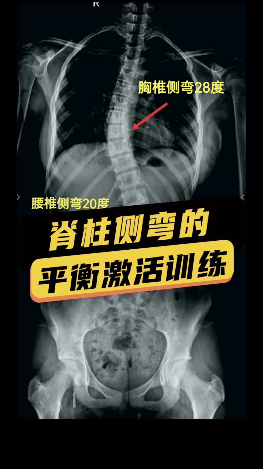 不一样的人生脊柱侧弯会导致高低肩驼背你知道她在做什么训练