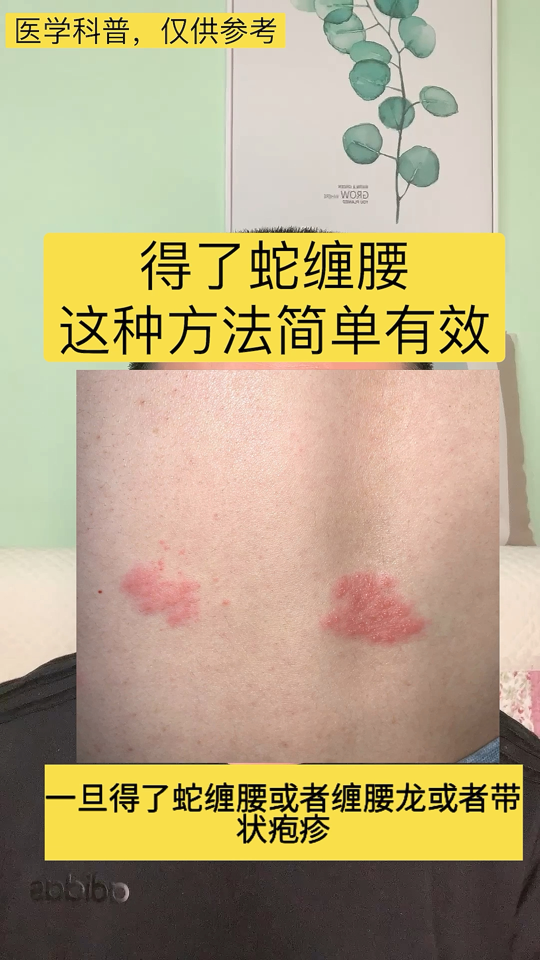 全民医生说#缠腰蛇或者缠腰龙,不少人深受其害,痛不欲生,别担心,我