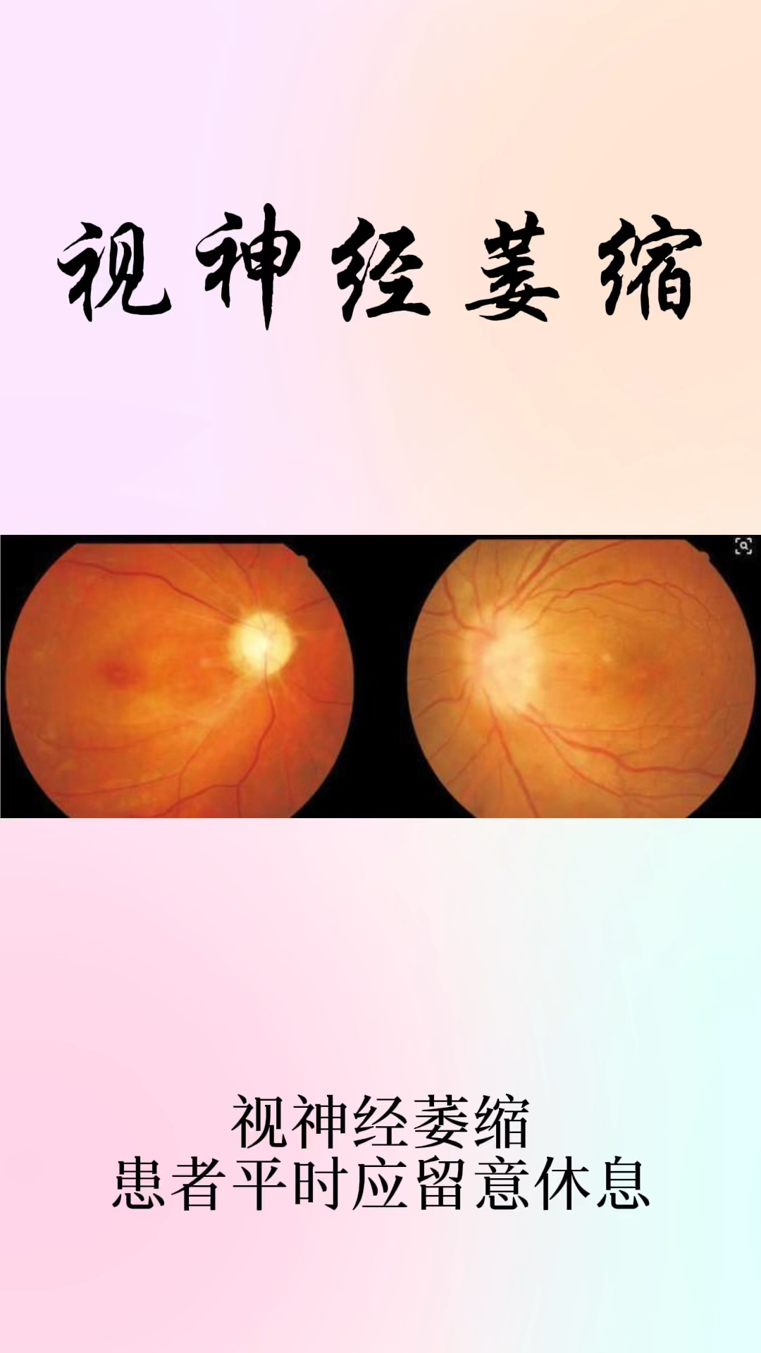 破壳计划#视神经萎缩患者平时应注意