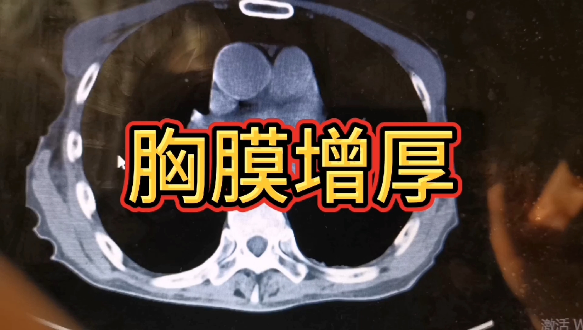 胸膜增厚胸部体检报告单上提示胸膜增厚增厚在ct上怎么看临床意义有是