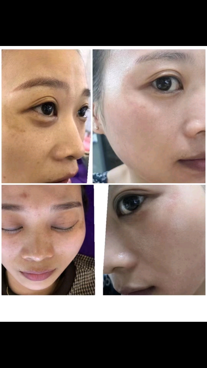 美白祛斑#斑斑困扰我多年,刚刚发现现了一个好东西,可以看下我的变化