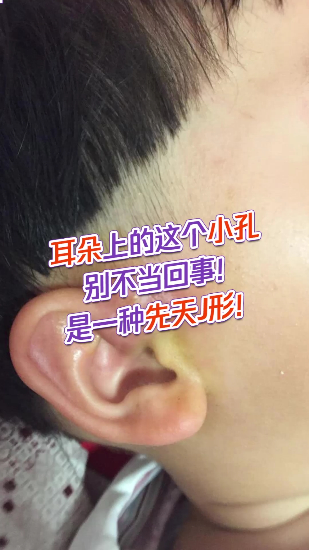 耳朵上有"富贵孔"可不是什么好事!