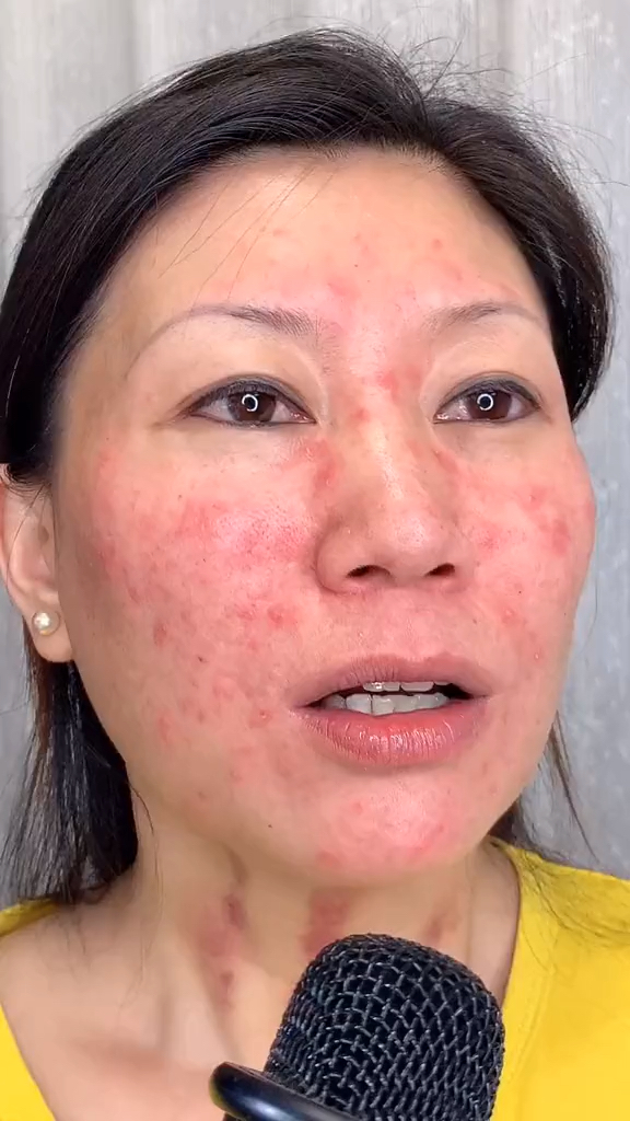 激素脸#经历过烂脸折磨的滋味!满满变的勇敢和坚强!现在已是黑历史