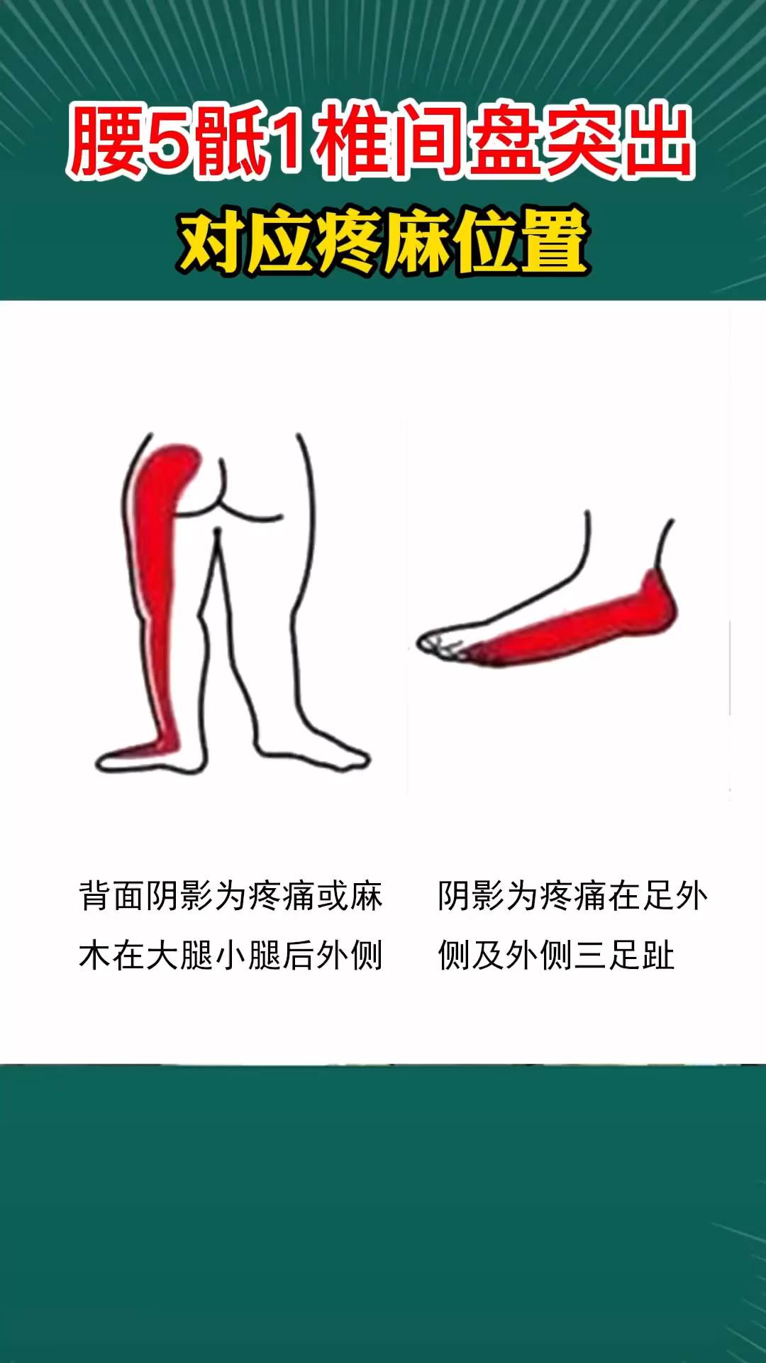 腰间盘突出哪里疼图片图片