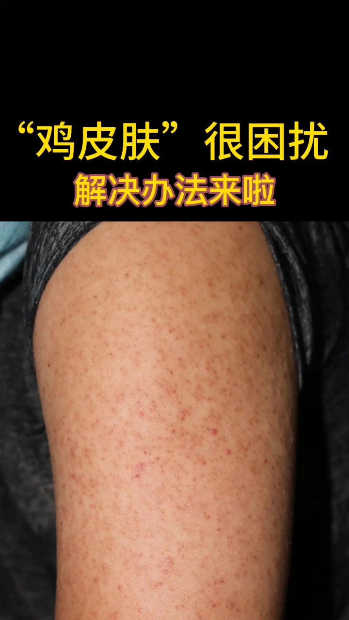 鸡皮肤要怎么治疗有效的简单介绍