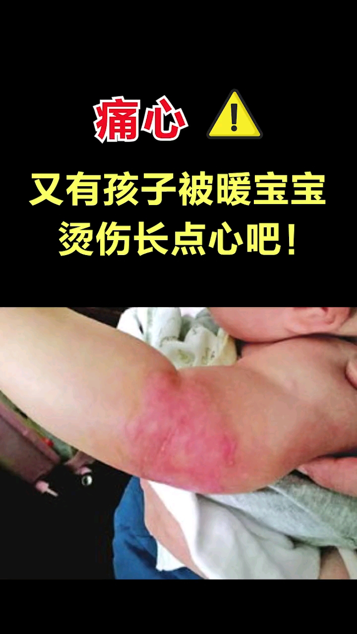 育儿#给孩子贴暖宝宝,小心孩子被体温烫伤!-度小视