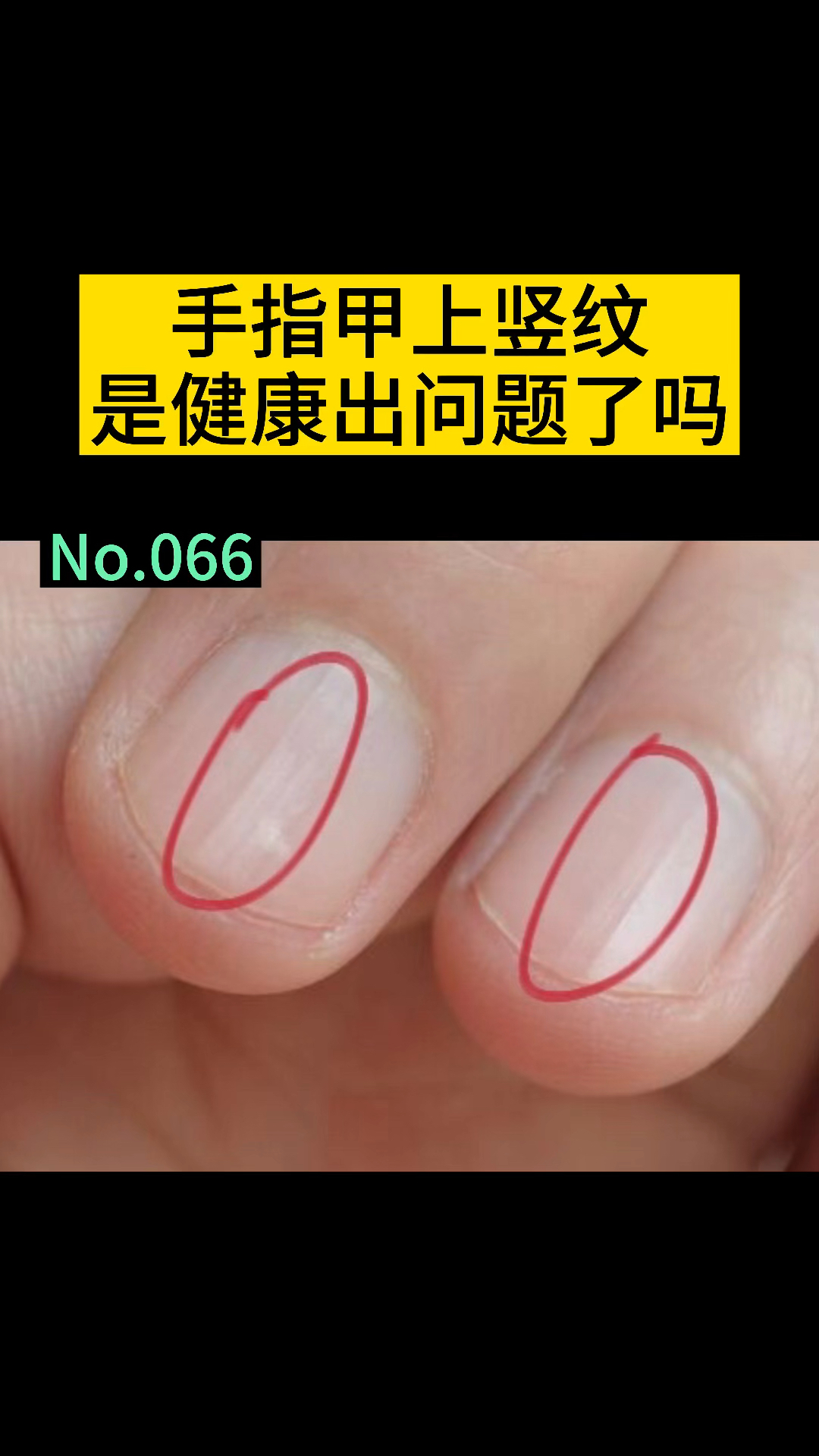 健康科普手指甲上的竖纹是身体健康出问题了吗