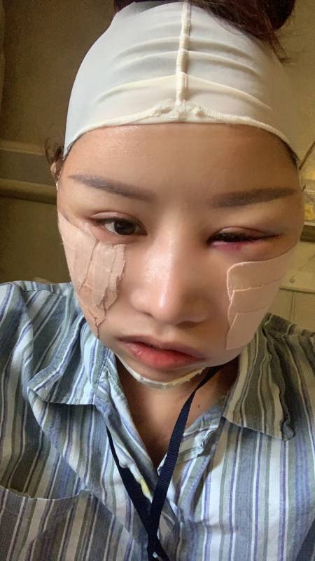 磨骨手术第一天颧骨比较突出两边大小不对称,所以右边为了对称多磨了