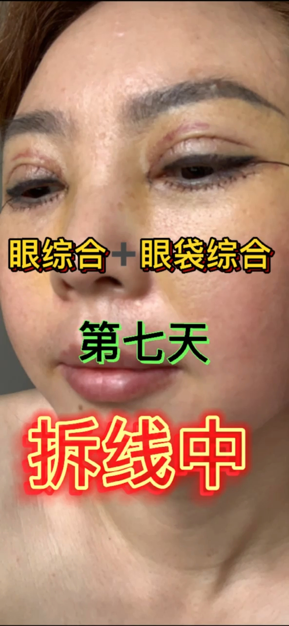 双眼皮眼综合77眼袋综合7天拆线马上看效果吧记得关哦不然找不到了